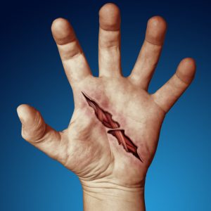 wounded hand